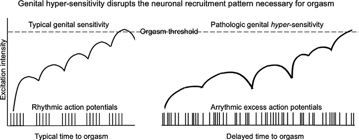 Delayed Orgasm From Lumbosacral Disc Disease Role of the